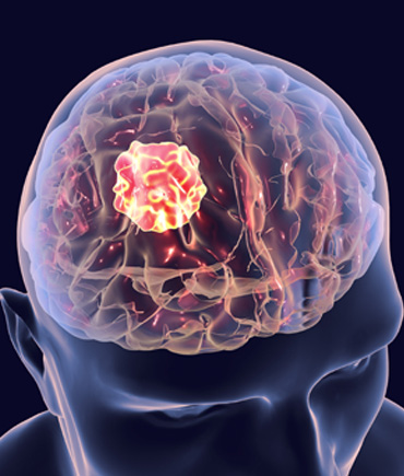 What is brain tumor?
