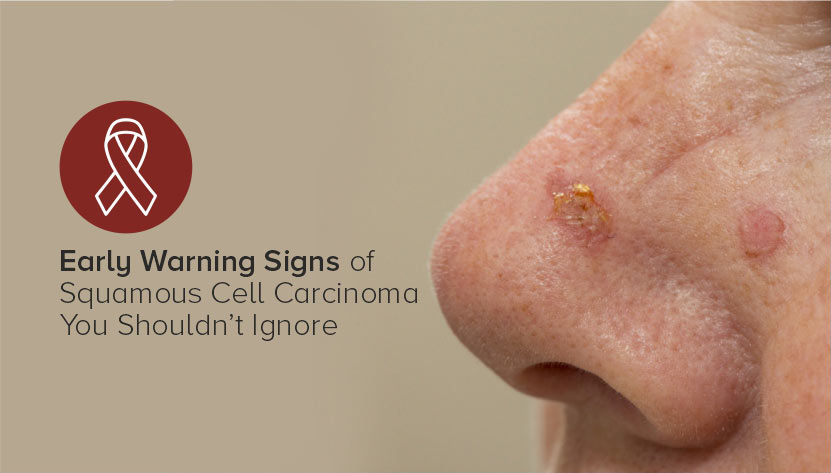 Early Warning Signs Of Squamous Cell Carcinoma You Shouldn t Ignore